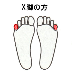 X脚の方：足の外側を平行にして、小指側に重心をかける